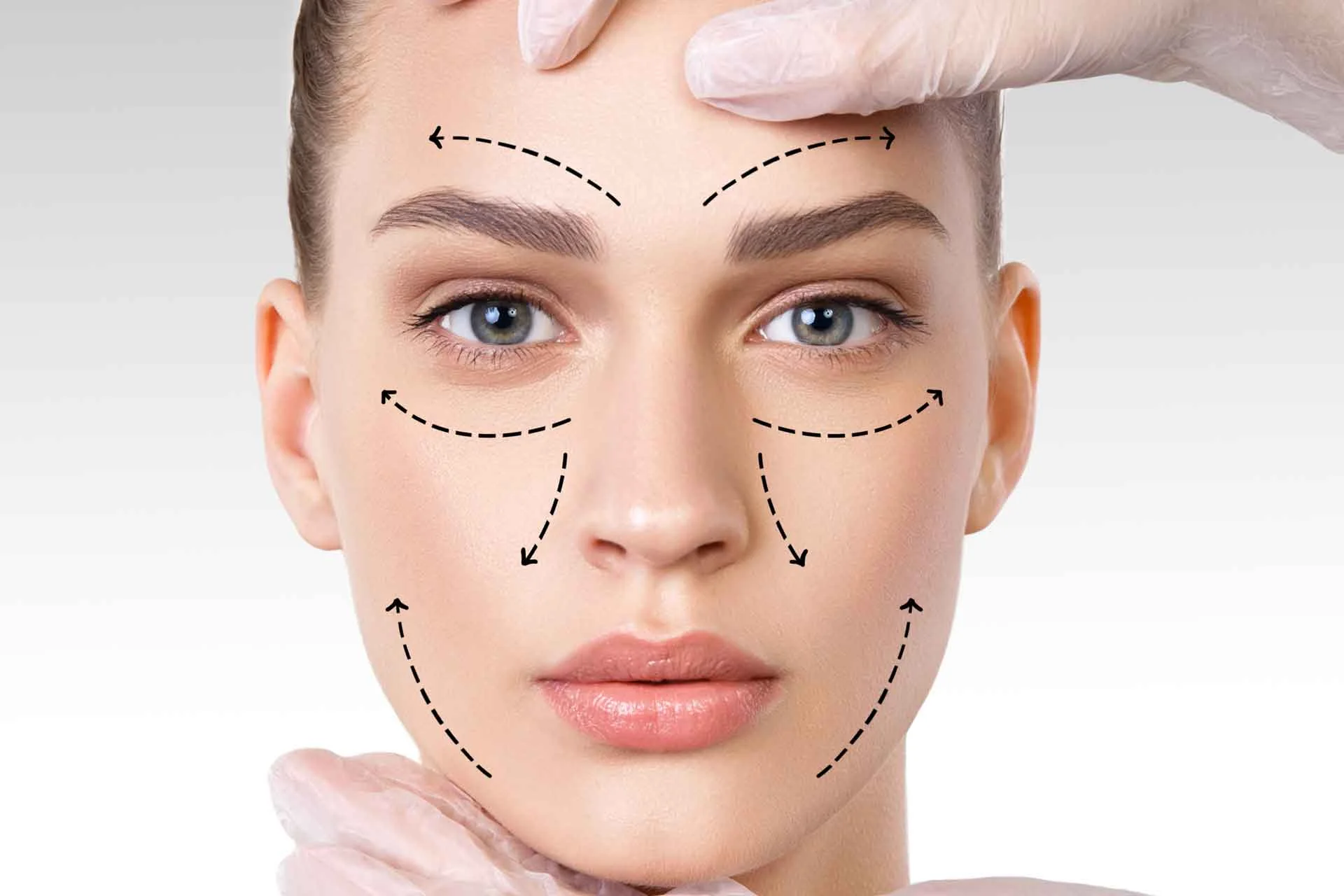 Tratamiento de hidroxiapatita de calcio - Bioestimulación